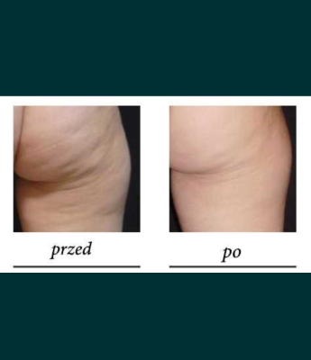 Ogłoszenie - Masaż kawitacyjny. Zdjęcie 2