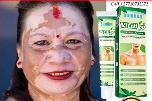 Ogłoszenie - Get Rid Of Vitiligo In Vaasa City In Finland Call +27710732372 Scars And Stretch Marks In Asomatos In Kyrenia, Cyprus. Zdjęcie 1