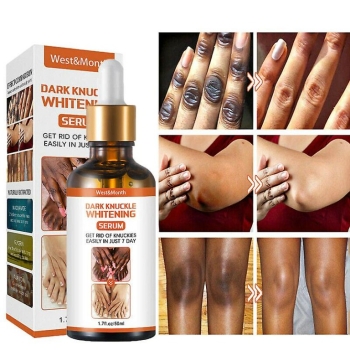 Ogłoszenie - Dark Knuckle Whitening Serum In Oman, Knee Brightening Serum In Agios Georgios In Kyrenia, Cyprus Call ☏ +2771 073 2372 - Poznań - 4 100,00 zł
