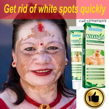 Ogłoszenie - Get Rid Of Vitiligo In Vaasa City In Finland Call +27710732372 Scars And Stretch Marks In Asomatos In Kyrenia, Cyprus - Brodnica - 4 100,00 zł